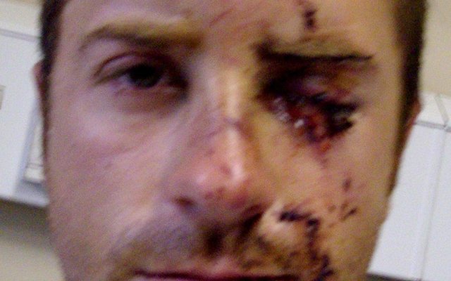 Riaan Burger, wat 4 jaar gelede ernstig by Montego’s aange-rand is, se snymerke kan hier gesien word terwyl hy in die hospitaal behandel is.